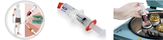 Eigenblutbehandlung - ACP